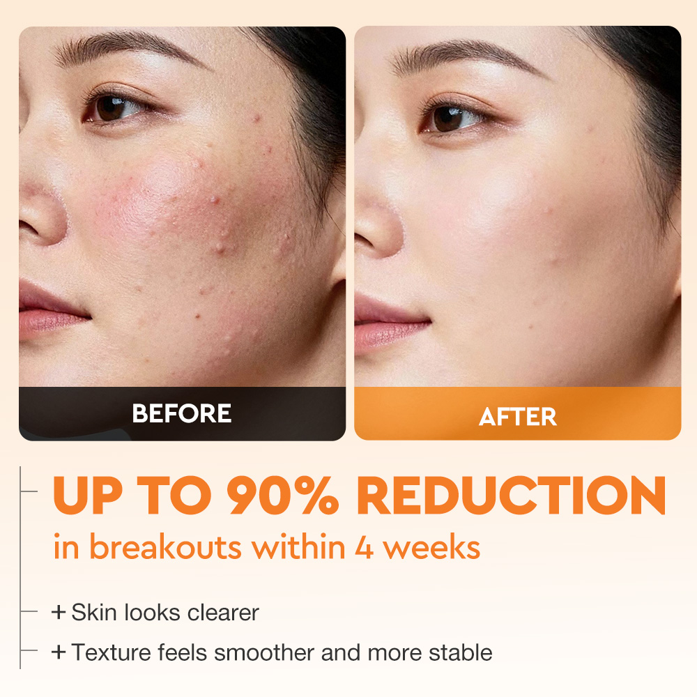 Wholesale Skinever Oil Control Salicylic Acid Rapid Acne Gel Serum Face Skincare Products Soothing Facial Serum